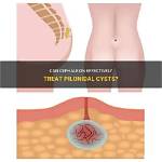 Can Cephalexin Be Used for Cysts?