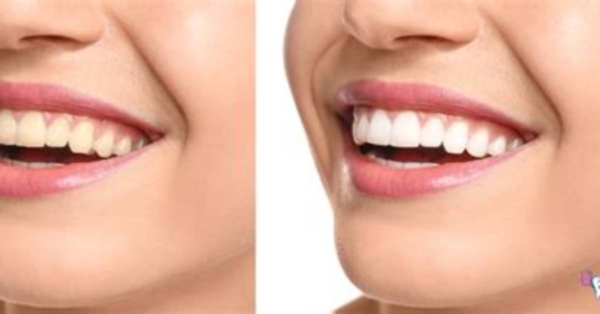 Can Chewing Gum Whiten Your Teeth?