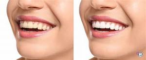 Can Chewing Gum Whiten Your Teeth?