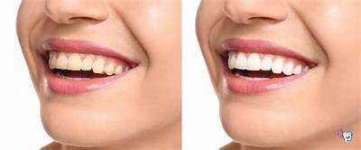 Can Chewing Gum Whiten Your Teeth?
