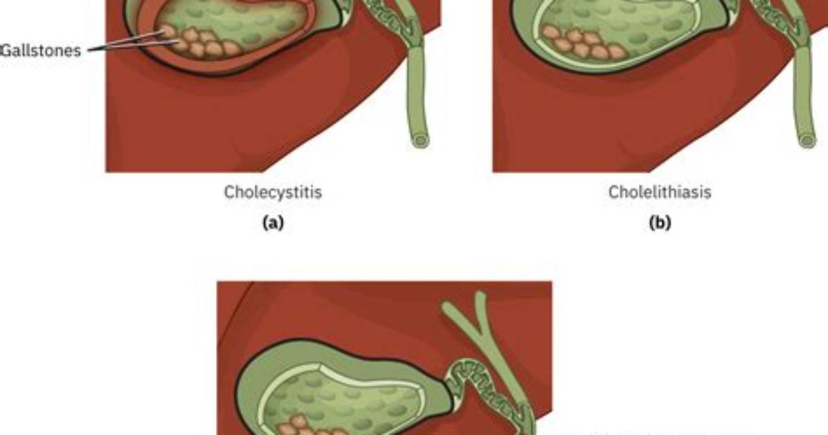 Can Cholecystitis Cause Altered Mental Status?