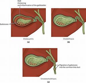 Can Cholecystitis Cause Altered Mental Status?