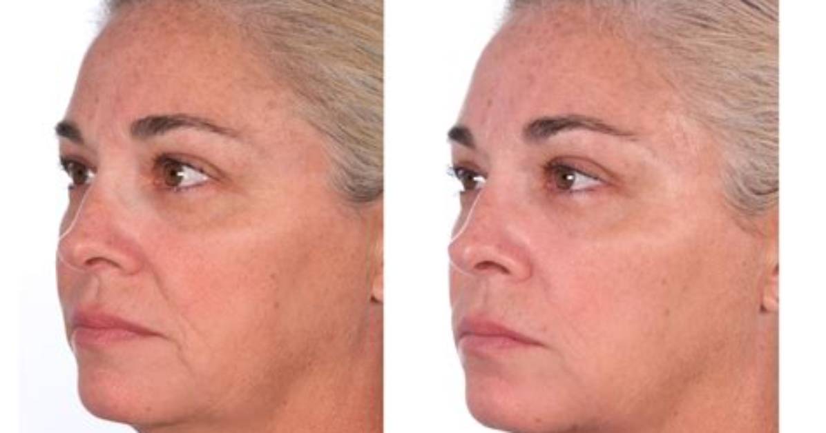 Can Collagen Help with Sagging Skin?