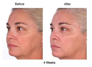 Can Collagen Help with Sagging Skin?