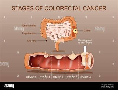 Can Colon Cancer Grow in 4 Year's?