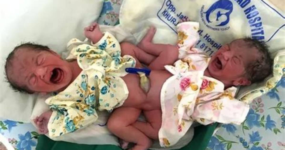 Can Conjoined Twins Be Born Naturally?