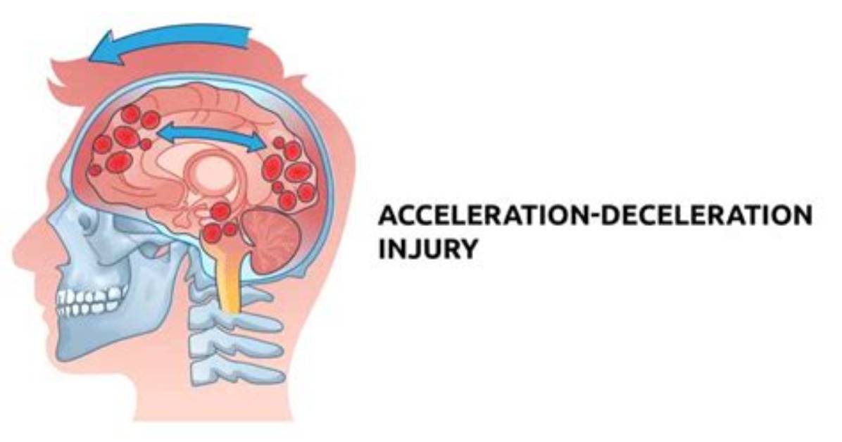 Can Deceleration Kill You?
