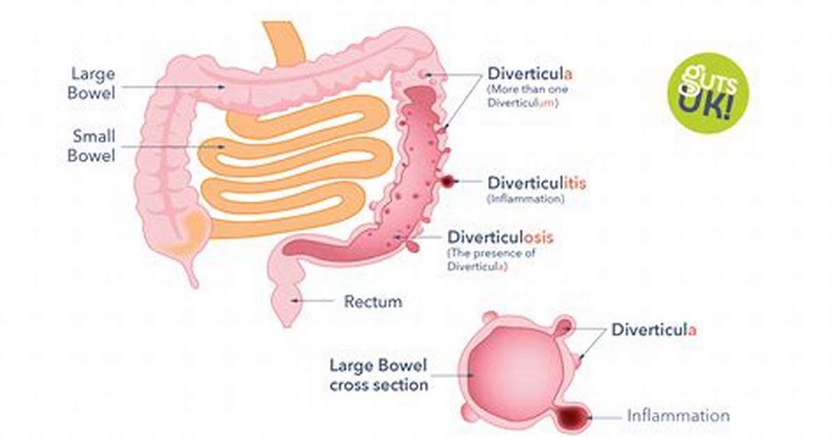 Can Food Get Stuck in Diverticula?