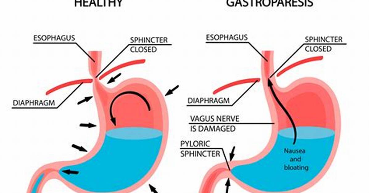 Can Gastroparesis Cause Death?