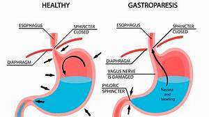 Can Gastroparesis Cause Death?
