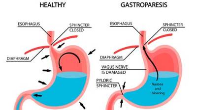 Can Gastroparesis Cause Death?