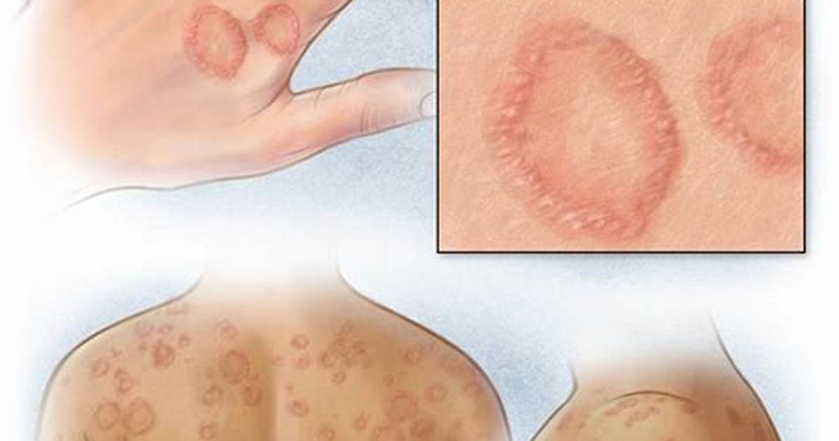 Can Granulomas Be Mistaken for Cancer?