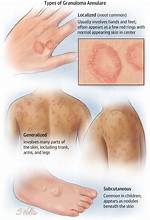 Can Granulomas Be Mistaken for Cancer?