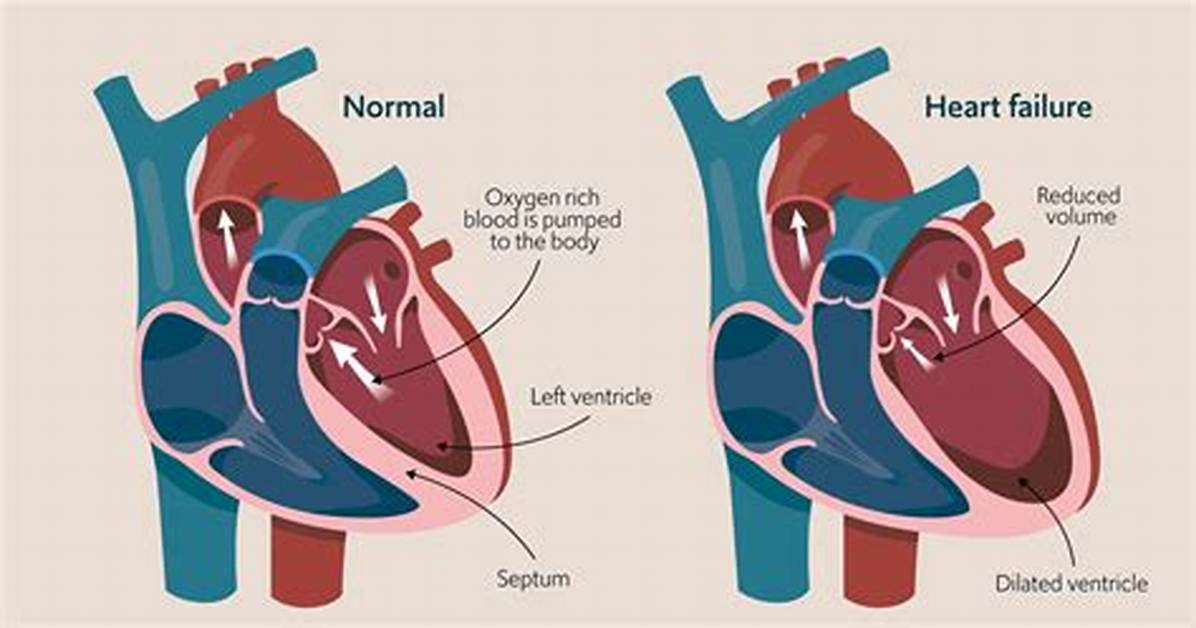 Can Heart Failure Affect Walking?