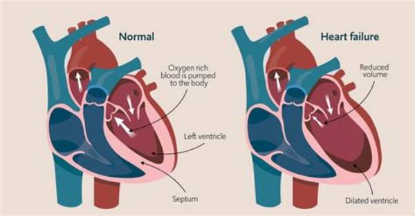 Can Heart Failure Affect Walking?