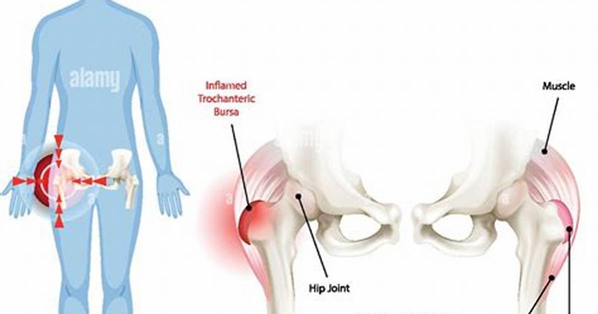 Can Hip Bursitis Cause Leg Pain?