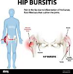 Can Hip Bursitis Cause Leg Pain?
