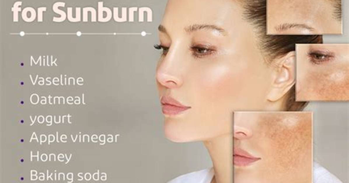 Can Honey Clear Sunburn?