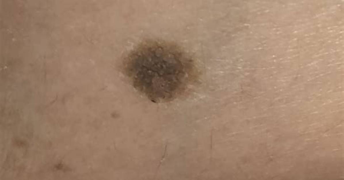 Can Hormones Cause Melanoma?