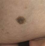 Can Hormones Cause Melanoma?