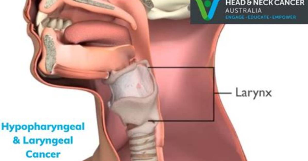 Can Hypopharyngeal Be Cured?