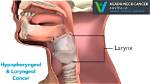 Can Hypopharyngeal Be Cured?