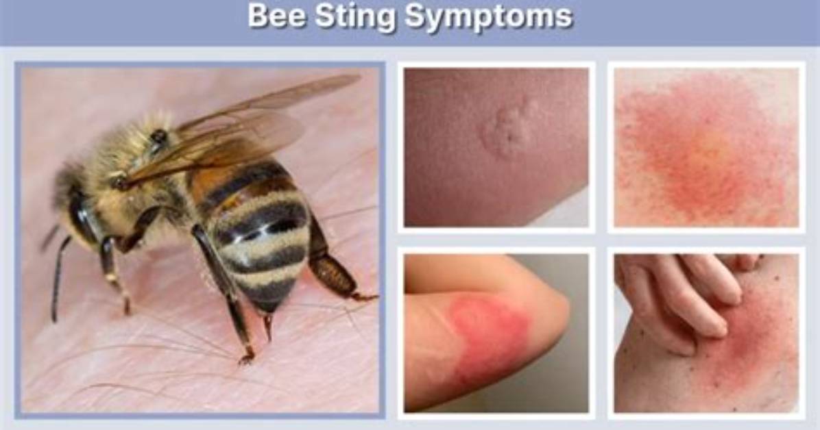 Can I Drink Alcohol After Bee Sting?