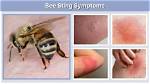 Can I Drink Alcohol After Bee Sting?