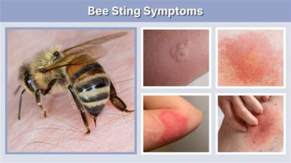 Can I Drink Alcohol After Bee Sting?