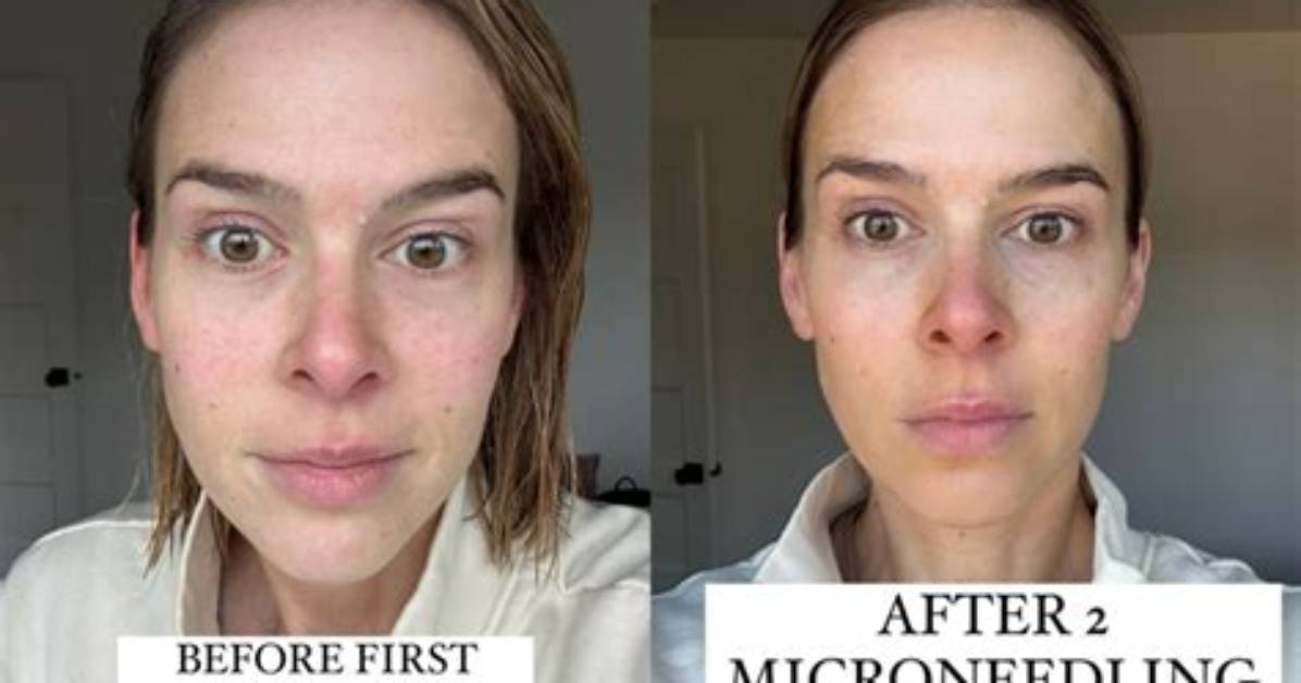 Can I Get Fillers After Microneedling?