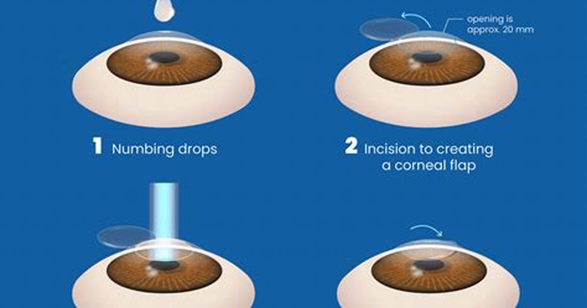 Can I Look at Screens After Lasik?