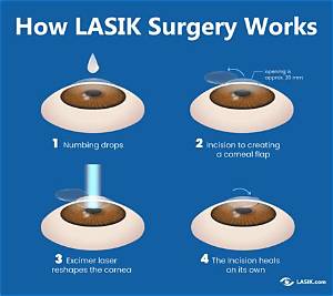 Can I Look at Screens After Lasik?