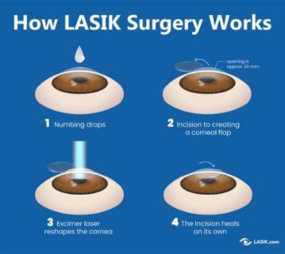 Can I Look at Screens After Lasik?