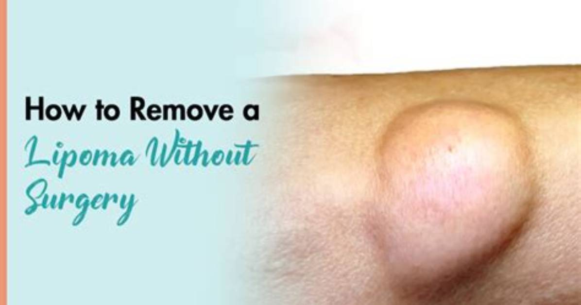 Can I Massage a Lipoma Away?