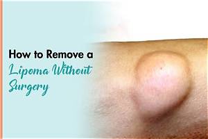 Can I Massage a Lipoma Away?