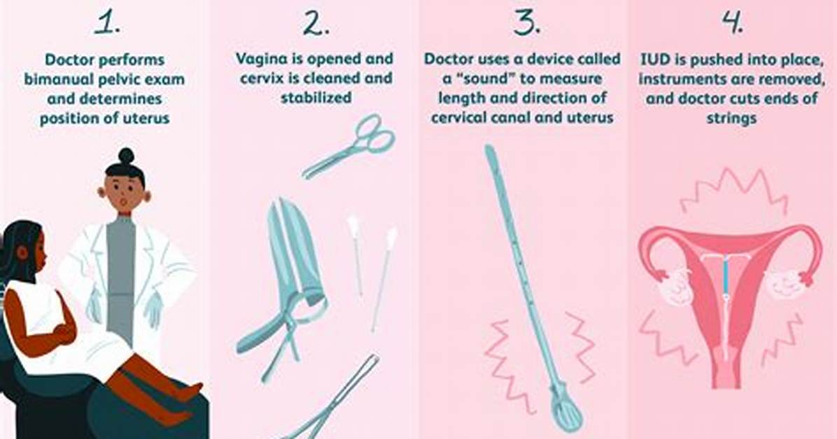 Can I Run After Iud Insertion?