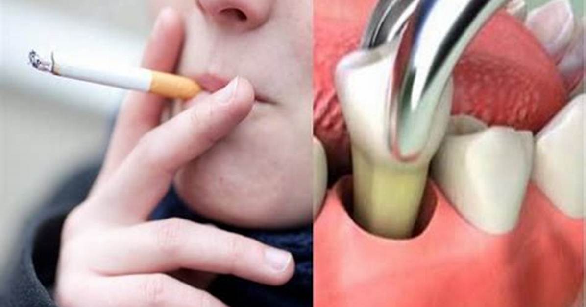 Can I Smoke Gently After Tooth Extraction?