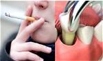 Can I Smoke Gently After Tooth Extraction?