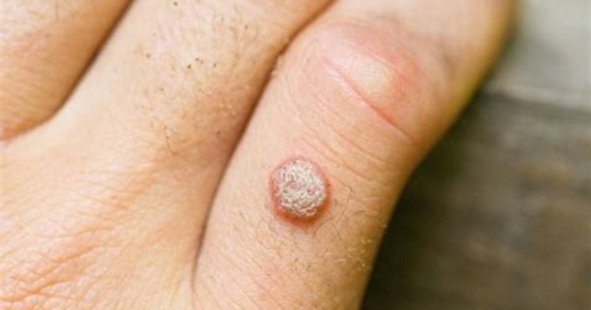 Can I Spread Warts to Myself?