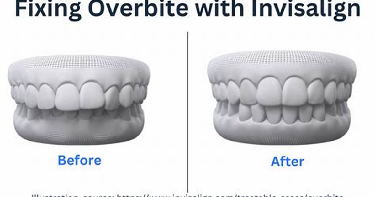 Can Invisalign Help Clenching?