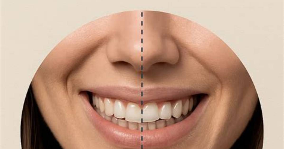 Can Invisalign Widen Smile?