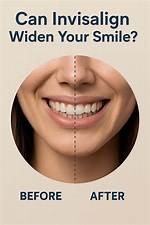 Can Invisalign Widen Smile?