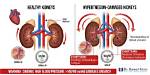 Can Kidney Damage from High Blood Pressure Be Reversed?