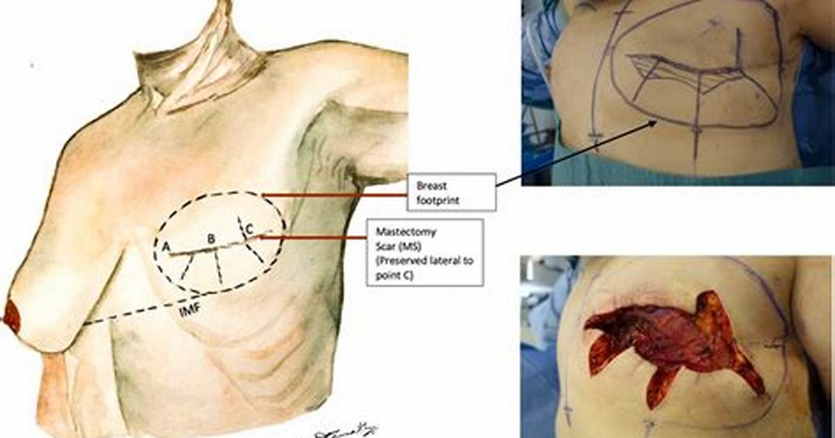 Can Mastectomy and Reconstruction Be Done in One Surgery?