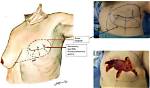 Can Mastectomy and Reconstruction Be Done in One Surgery?