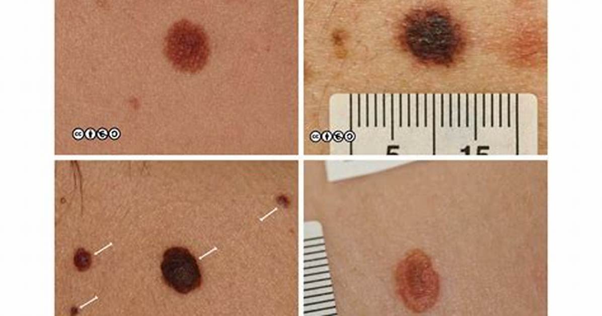 Can Melanoma Be 1Mm Wide?