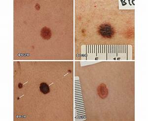 Can Melanoma Be 1Mm Wide?