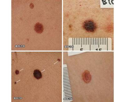 Can Melanoma Be 1Mm Wide?