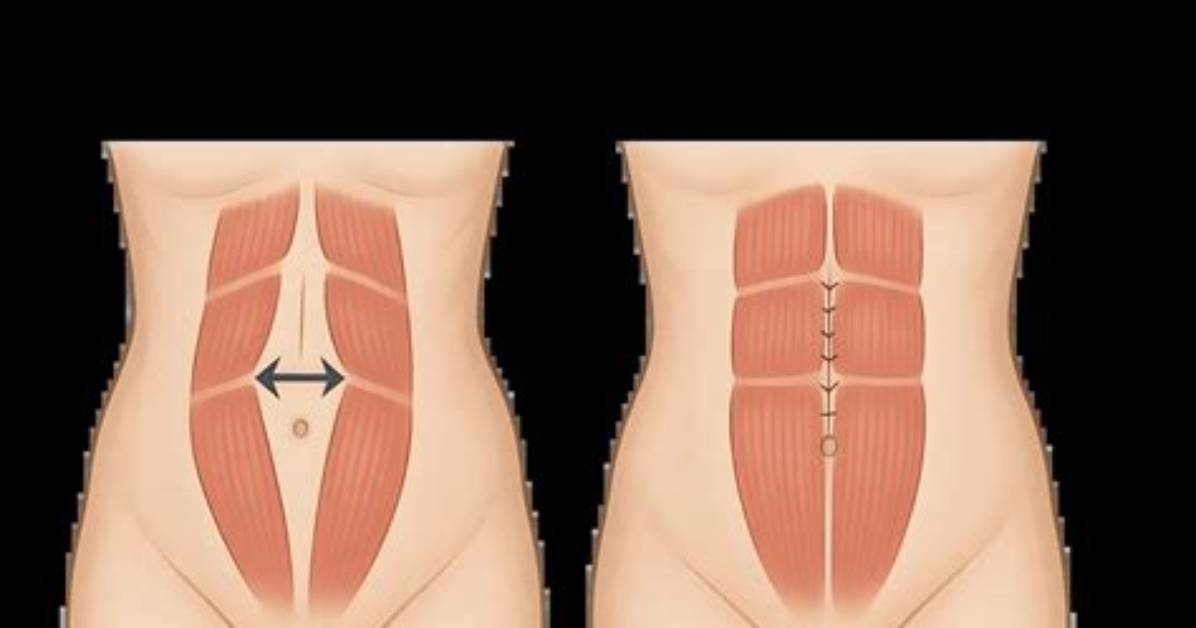 Can Muscles Separate After Tummy Tuck?