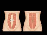 Can Muscles Separate After Tummy Tuck?